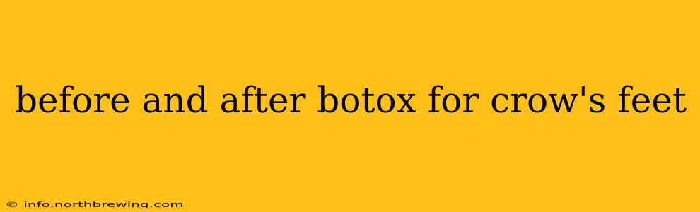 before and after botox for crow's feet