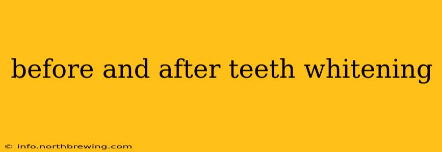 before and after teeth whitening