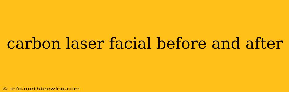 carbon laser facial before and after