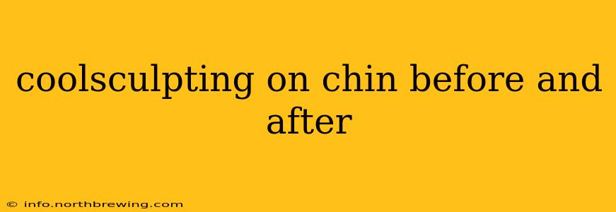 coolsculpting on chin before and after