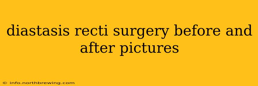 diastasis recti surgery before and after pictures