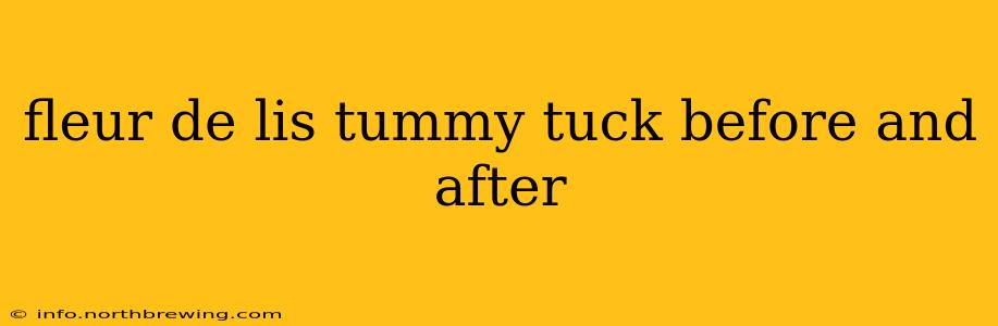 fleur de lis tummy tuck before and after