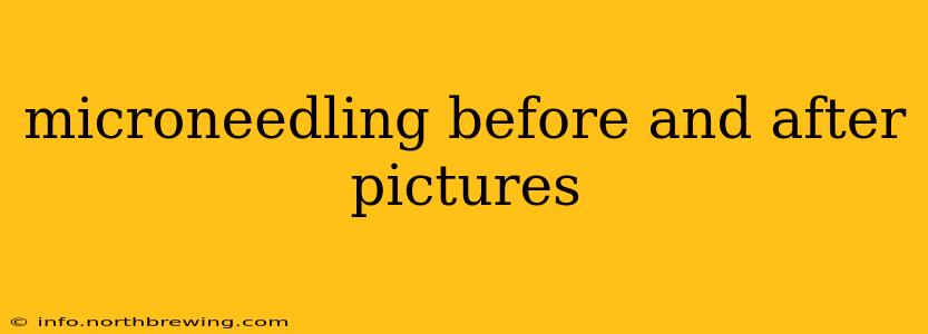 microneedling before and after pictures