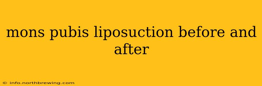 mons pubis liposuction before and after