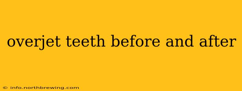 overjet teeth before and after