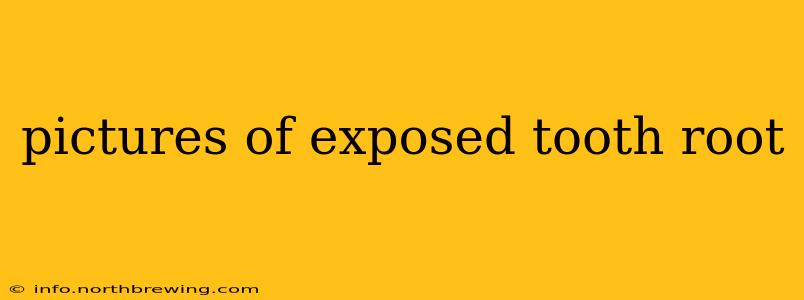 pictures of exposed tooth root