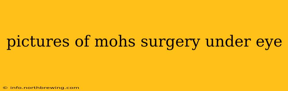 pictures of mohs surgery under eye
