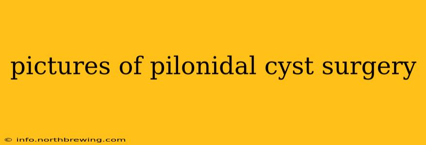 pictures of pilonidal cyst surgery