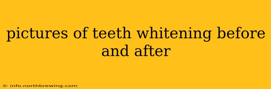 pictures of teeth whitening before and after