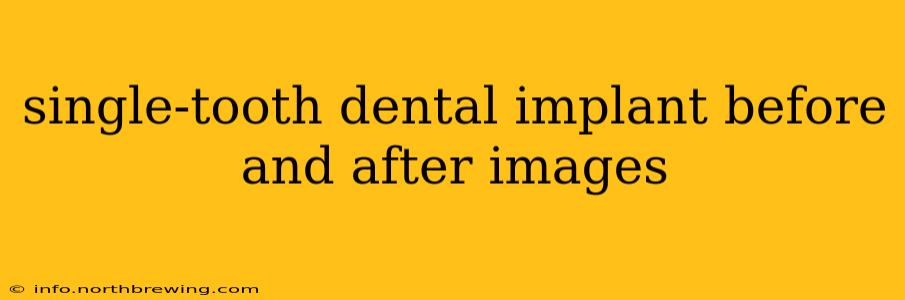 single-tooth dental implant before and after images