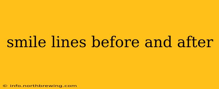 smile lines before and after