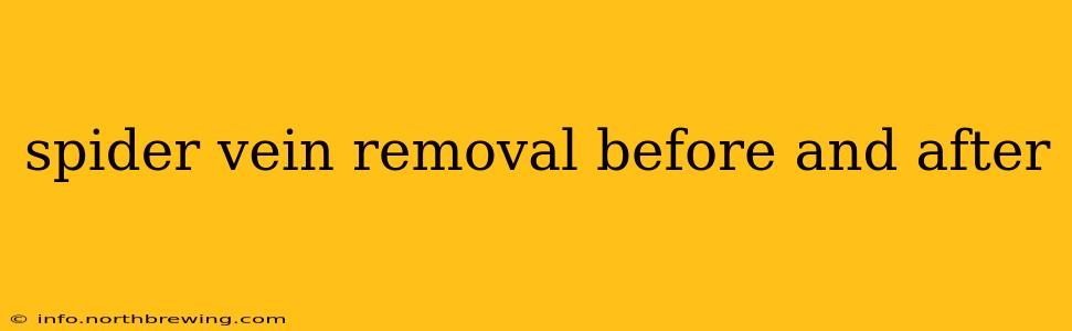 spider vein removal before and after
