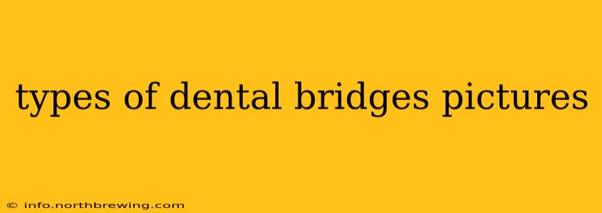 types of dental bridges pictures