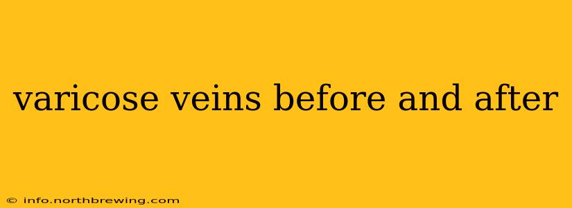 varicose veins before and after