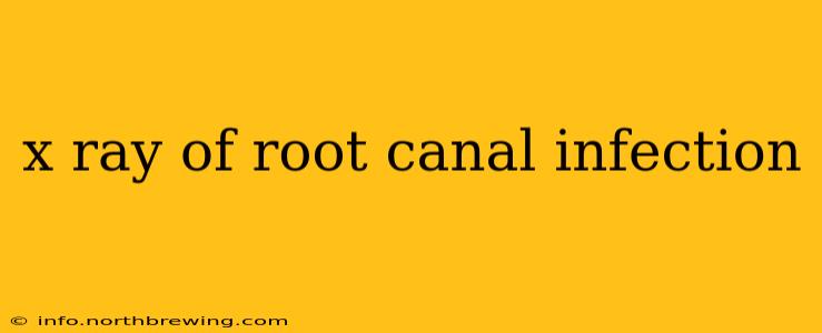 x ray of root canal infection